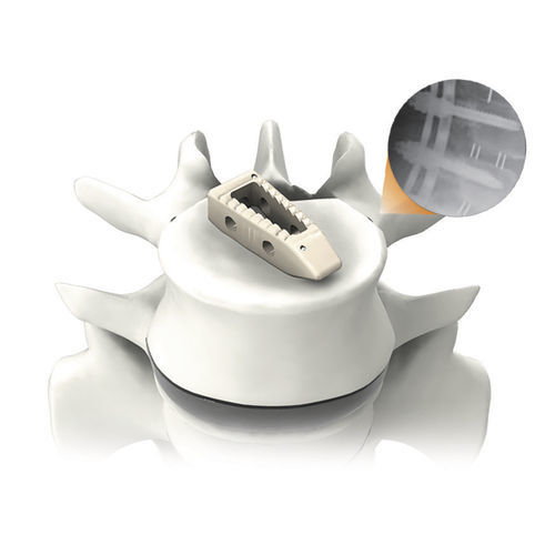 胸腰椎间融合器 - PLATEAU®-P - Life Spine - 后入路 / PEEK材质