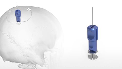不可吸收颅骨固定系统 - OsteoFlap™ - Acumed