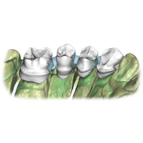 牙科软件 - Restoration - AGE Solutions - 实验室 / 培训 / CAD