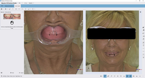 牙科软件模块 - 3D Denture Guide - AGE Solutions - 捕获