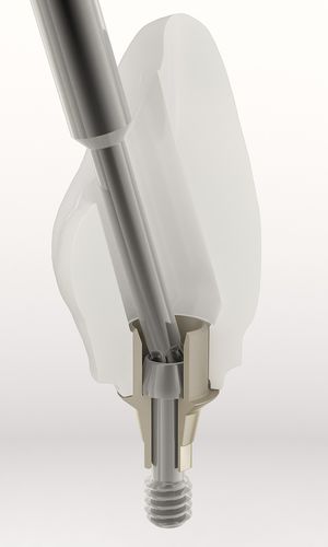 钛种植体基台 - BH - DESS AURUM Base™ - Dess Dental Smart Solutions - 外六角形 / 直线型