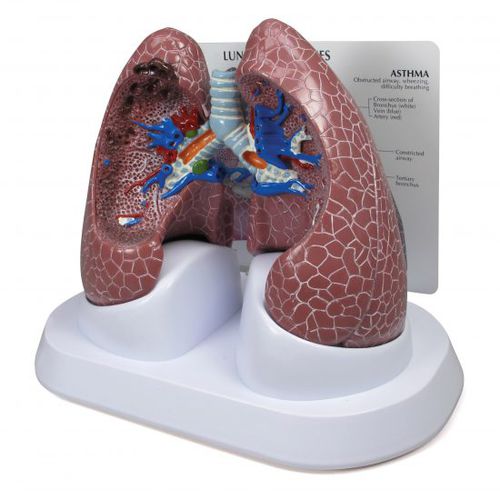 肺部解剖模型 - 3110 - GPI Anatomicals - 教学 / 用于癌症 / BPCO