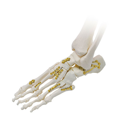 脚加压接骨板 - SIGNEX - OSTEONIC - 锁定 / 金属