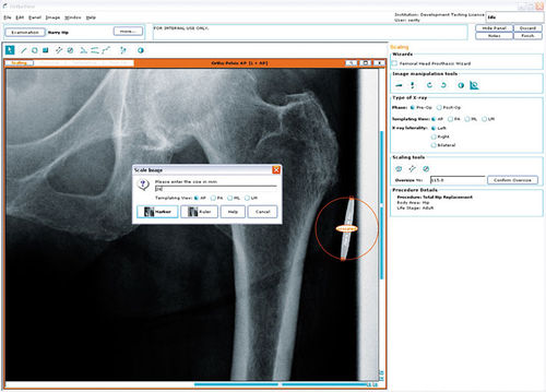 术前统筹软件 - Hip Arthroplasty - OrthoView - 用于胯骨手术 / 用于骨科手术 / 医用