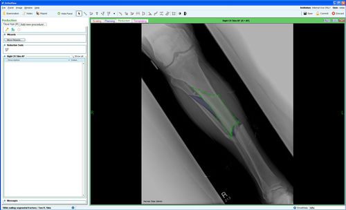 管理软件模块 - Fracture Management - OrthoView - 规划 / 用于骨科手术