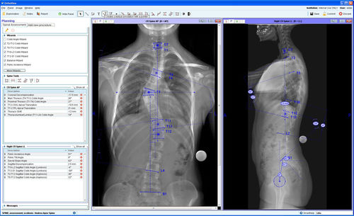 管理软件模块 - Spinal Deformity Assessment - OrthoView - 术前统筹 / 用于骨科手术 / 脊柱