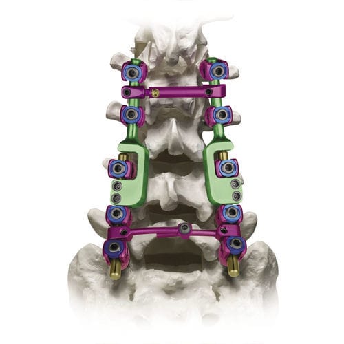 腰骶脊柱内固定系统 - REVERE® ADDITION® - Globus Medical - 后入路