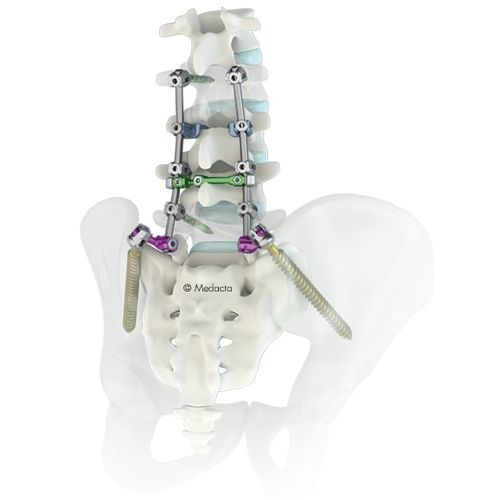腰骶脊柱内固定系统 - M.U.S.T.® - Medacta - 后入路