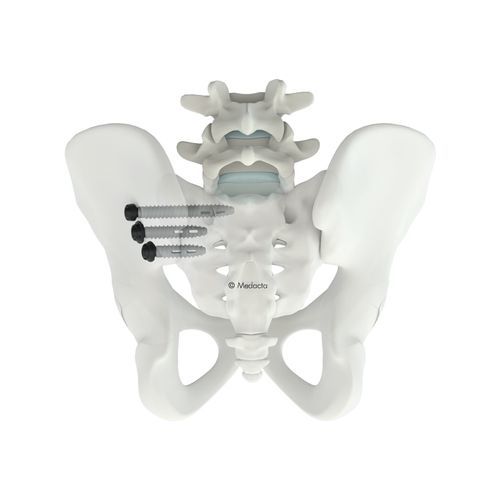 骶骨间脊柱内固定系统 - M.U.S.T.® SI - Medacta - 后入路