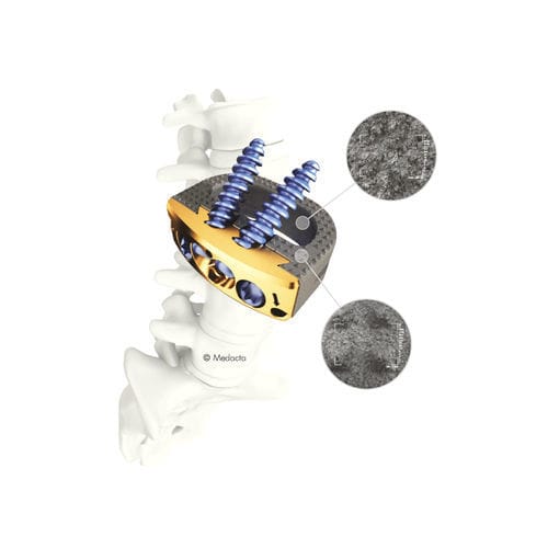 腰椎间融合器 - MectaLIF® - Medacta - 前入路 / 后入路 / PEEK材质