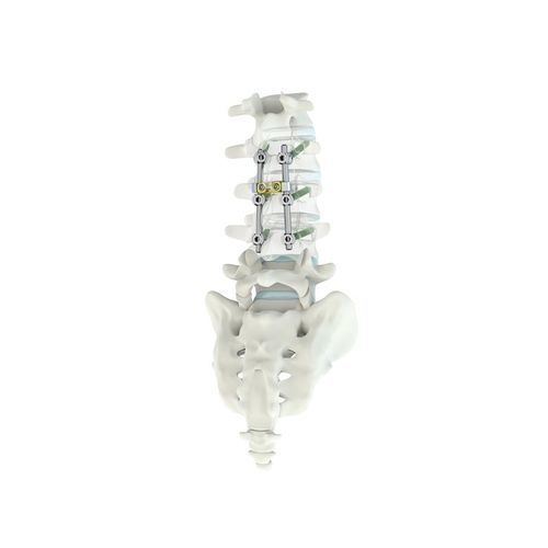 胸腰椎脊柱内固定系统 - M.U.S.T.® MC - Medacta - 后入路