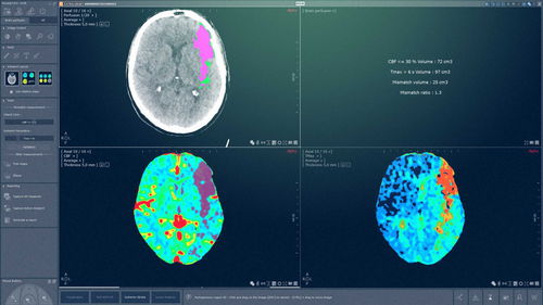 CT计算机断层扫描软件模块 - MYRIAN® XP-BRAIN - Intrasense - 神经系统 / 分析 / 管理