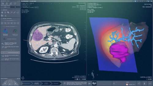 医用软件模块 - MYRIAN®XP-LIVER MRI - Intrasense - 分析 / 诊断 / 评估