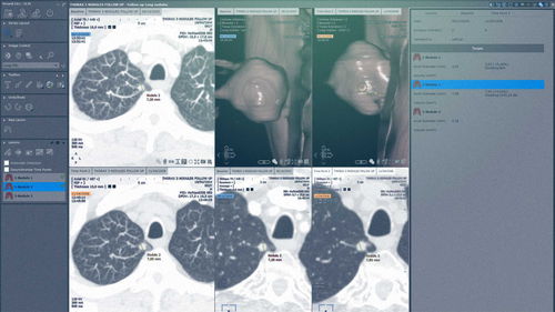 手术软件模块 - MYRIAN®XP-LUNG NODULE - Intrasense - 分析 / 可视化 / 评估