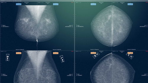 医用软件模块 - Myrian® XP-Mammo - Intrasense - 乳腺X射线造影 / 分析 / 可视化