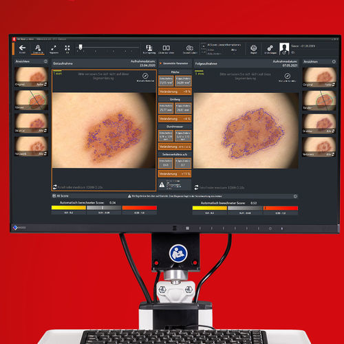 研究软件 - Moleanalyzer pro - FotoFinder Systems - 皮肤科 / 皮肤诊断 / 人工智能协助
