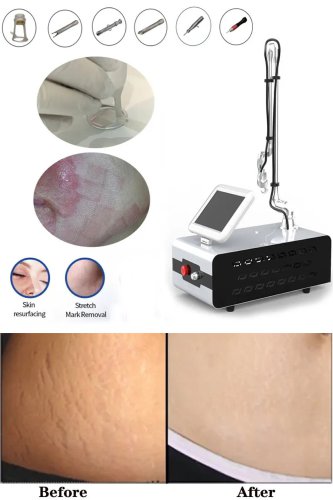 CO2 laser skin resurfacing machine fractional CO2 laser stretch marks