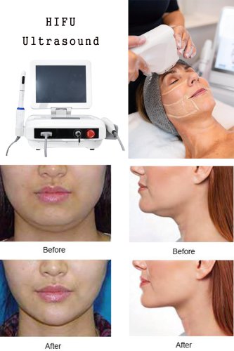 OEM HIFU anti-wrinkle machine. Professional HIFU machine manufacturer-BVLASER. HIFU high intensity focused ultrasound for face lifting.