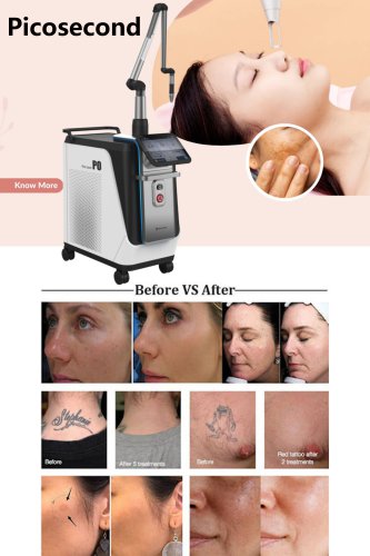 OEM picosecond laser machine. China picosecond laser in laser beauty equipment. CE certification picosecond laser tattoo removal machine.