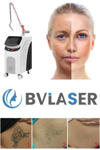 picosecond laser dermatology professional laser tattoo removal machine