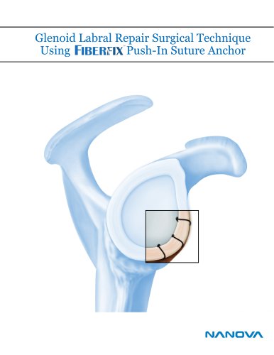 Glenoid Labral Repair Surgical Technique Using Push-In Suture Anchor