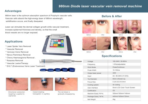 vascular removal laser-2