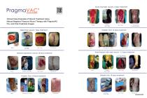 PragmaVAC® Wound Treatment Case Examples
