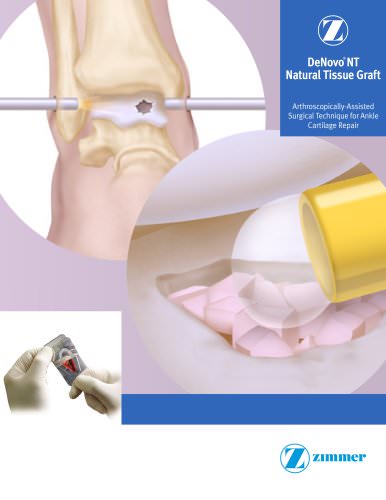 DeNovo® NT Natural Tissue Graft Arthroscopically-Assisted Surgical Technique for Ankle Cartilage Repair