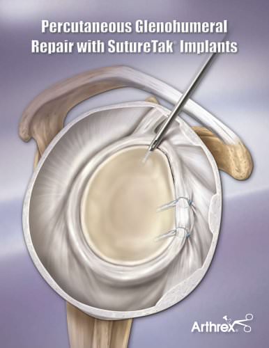 Percutaneous Glenohumeral Repair with SutureTak® Implants - LS0508